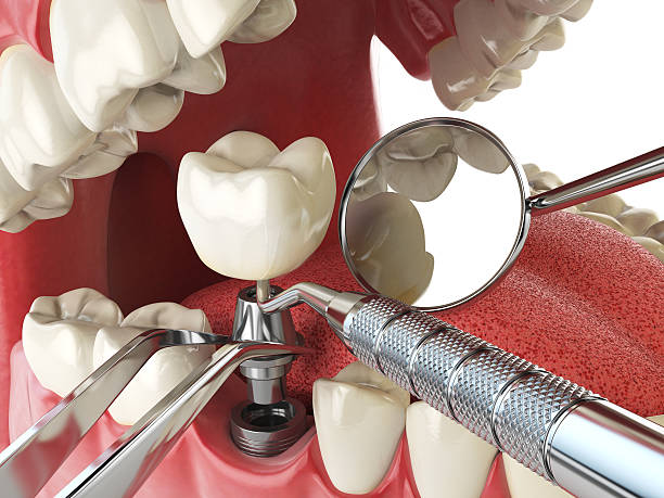 Best Emergency Wisdom Tooth Extraction in Goddard, KS